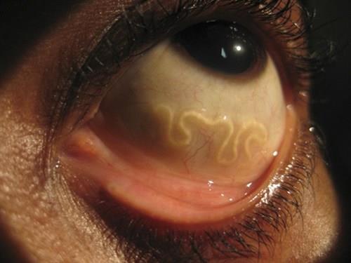 A kerekférgek megelőzése - Tünetek Kerekféreg leírása és kezelése Férgek élnek emberi szemekben
