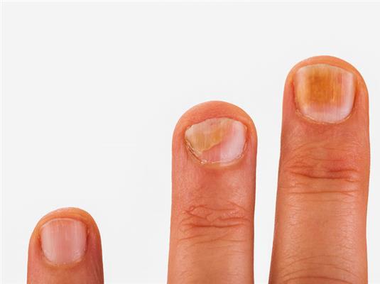 hogyan működik a szóda körömgomba nail fungus diagnosztika és kezelés