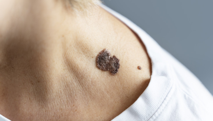 melanoma időskorban